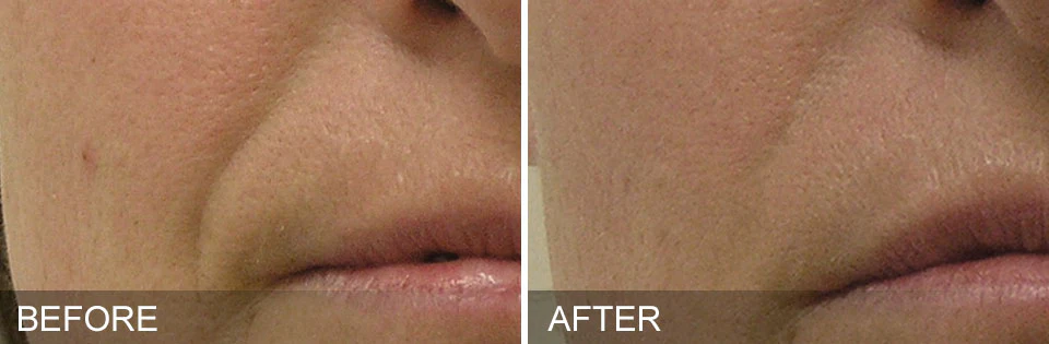 Hydrafacial® Deluxe - Image 4