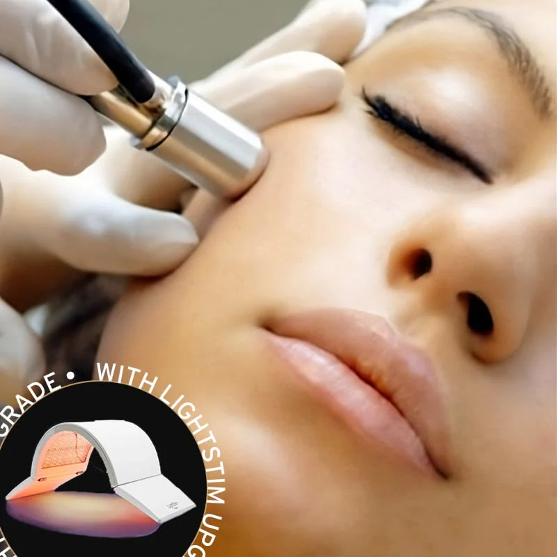 Microdermabrasion - Image 4