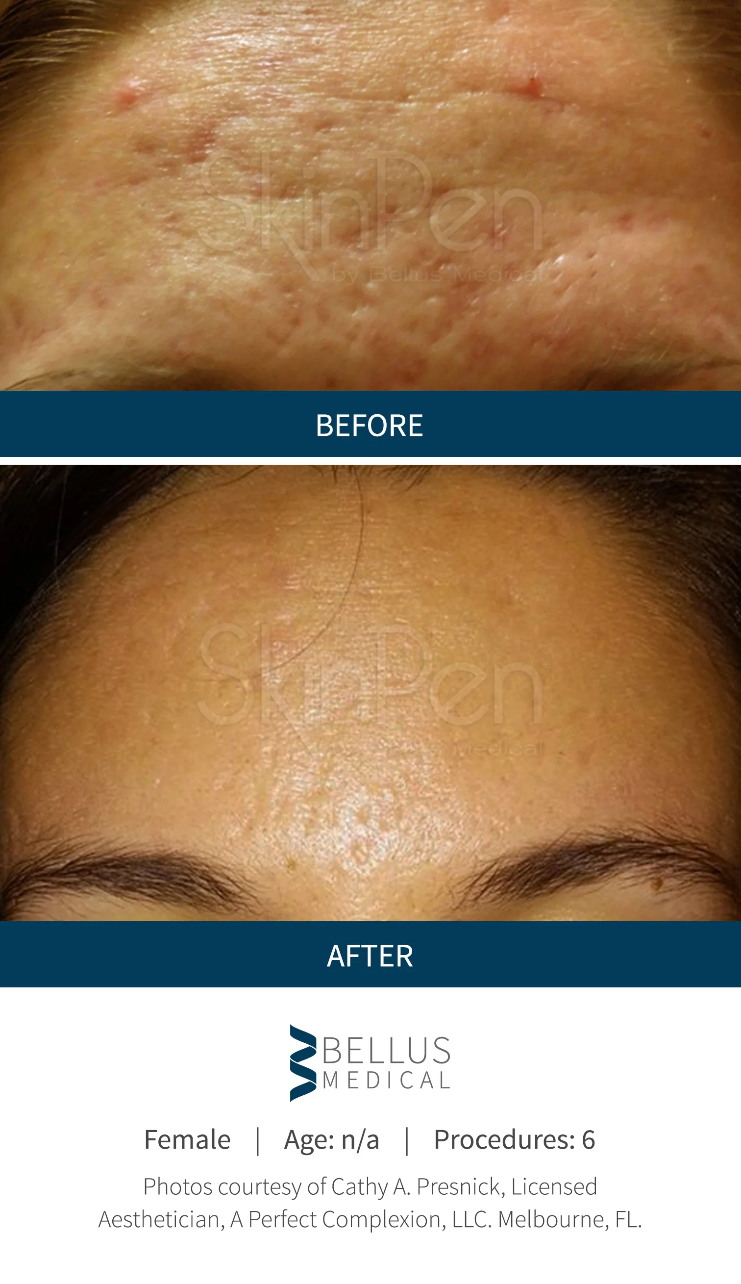 Collagen Induction Therapy (Microneedling) - Image 3