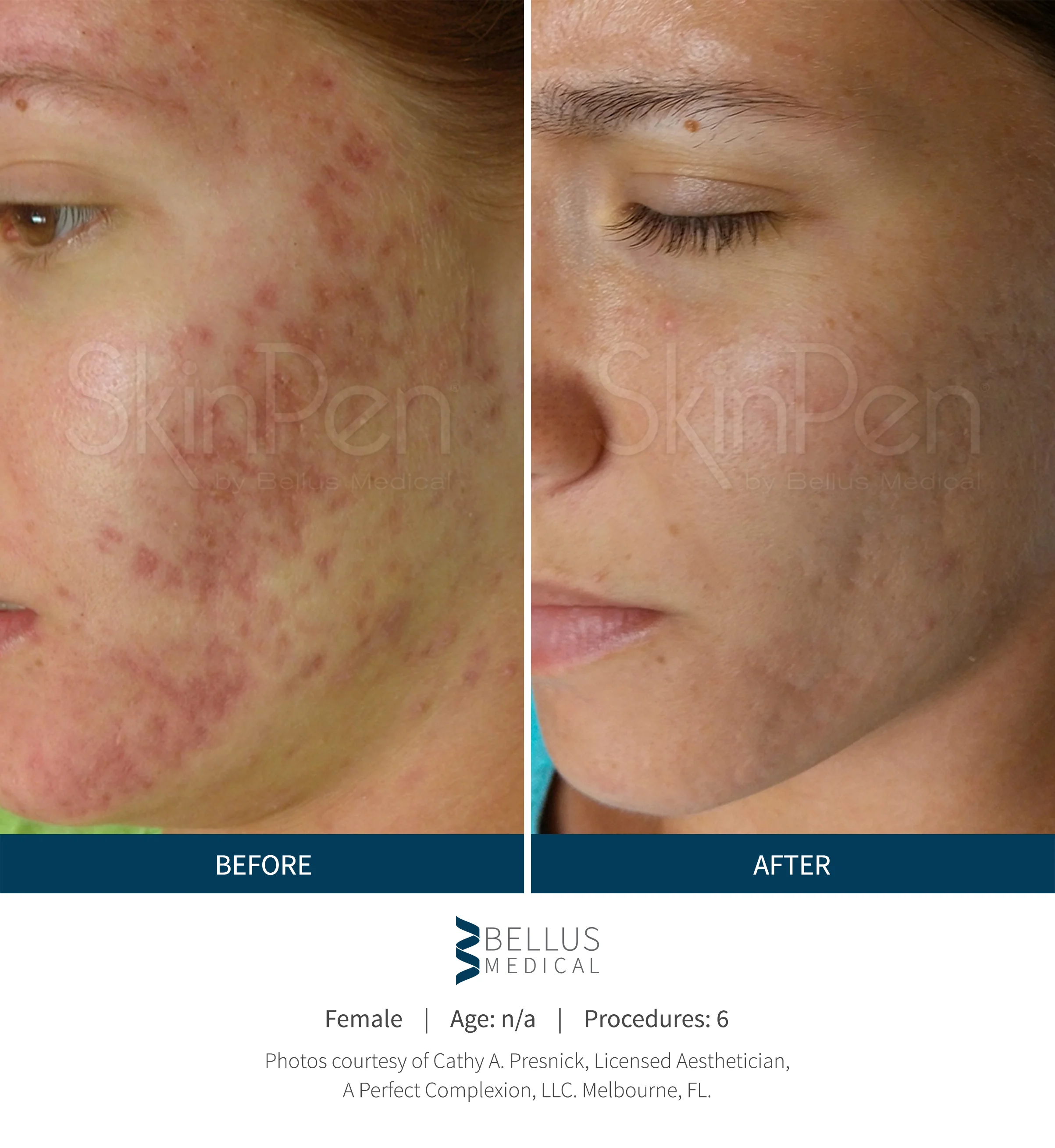 Collagen Induction Therapy (Microneedling) - Image 4