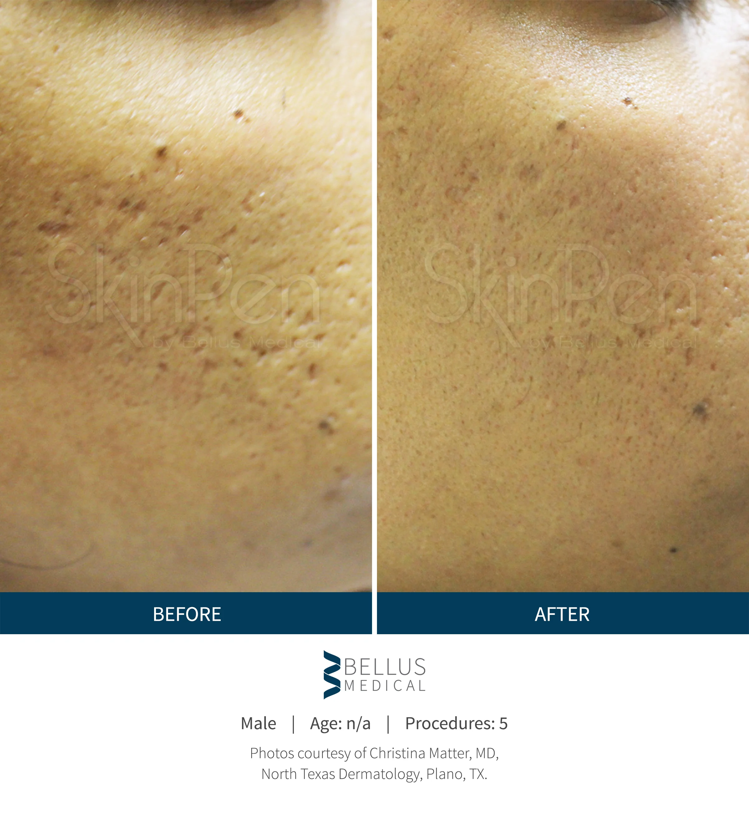 Collagen Induction Therapy (Microneedling) - Image 5
